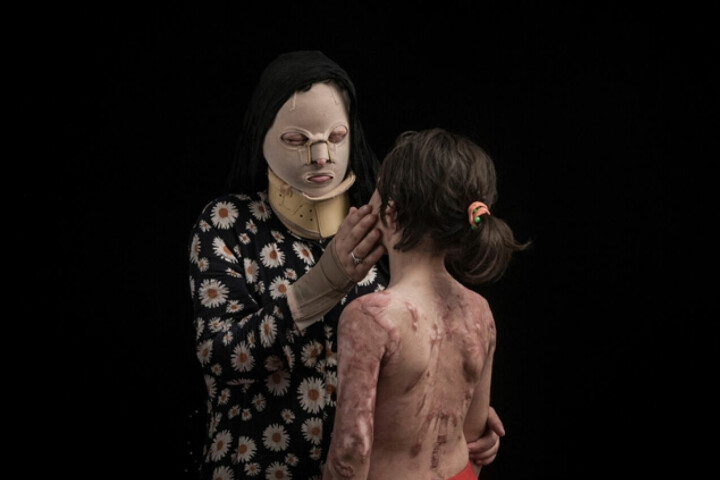38-årige Raana Por Amrai och Fatemeh Qalandari, 8 år. Raanas mans bror trodde att Raana var på väg att vilja skiljas och attackerade både henne och Fatemeh under juli 2015. Båda har behövt flera operationer, och många fler kommer att behövas, för att behandla skadorna på ögon, ansikte, händer, nacke och rygg.