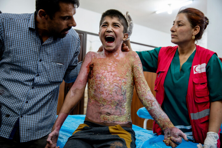 Årets Nyhetsbild Utland: 1:a pris: Niclas Hammarström, frilans/Expressen. Tell Tamr, Syrien. Mohammed Hamid 13 år skriker ut sin smärta. Hans hud nästan bubblar när han leds in på sjukhuset. Personalen på sjukhuset försöker trevande hitta en fläck på pojkens kropp att ta på utan att göra pojken illa. Mohammads pappa är lika chockad som sin son. Han berättar att flygplanet släppte sin bomb och när han bar sin skadade son så kom fler. Och sen ännu flera.